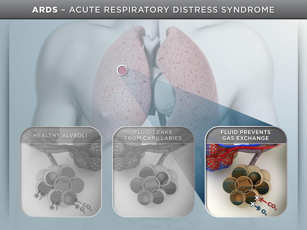 ards-medical-illustration-visual-advantage-courtroom-graphics