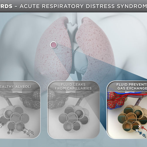 ARDS Medical Illustration