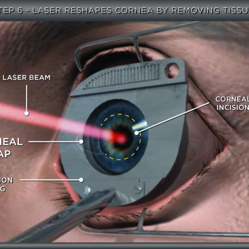 Corneal Reshaping