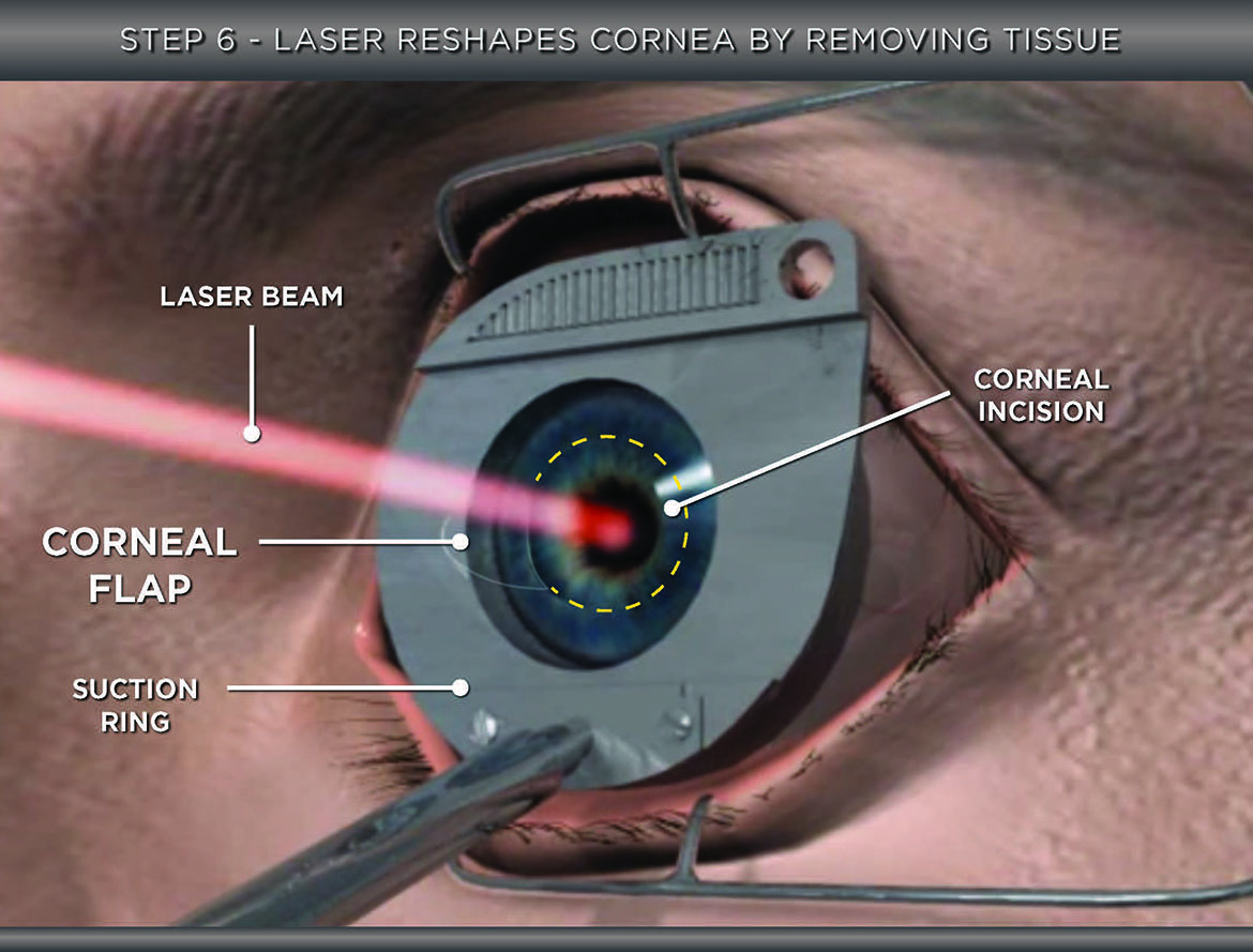 Courtroom graphics Corneal Reshaping of the Cornea with a Laser