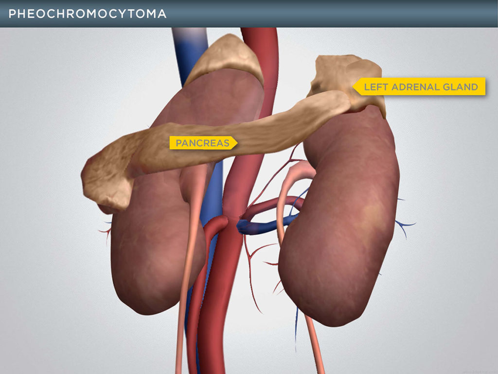 Illustration of Pheochromocytoma - Visual Advantage | Courtroom ...