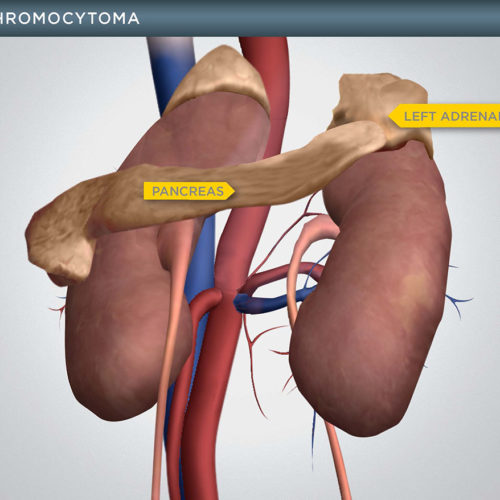 Illustration of Pheochromocytoma