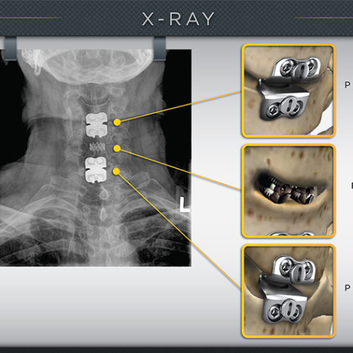 Rear X-Ray Spine