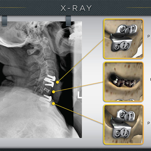 Side X-Ray Spine