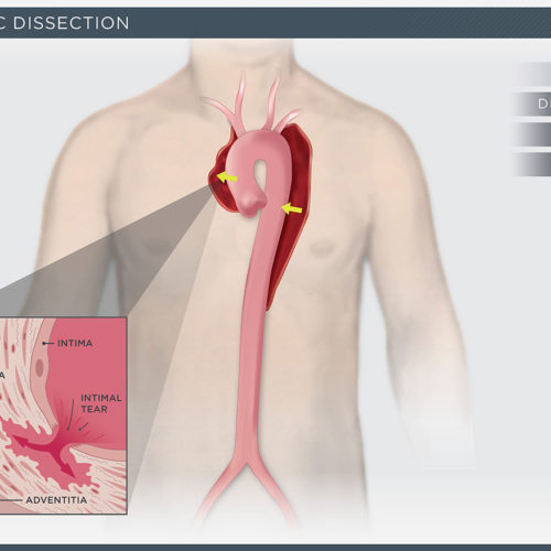 Aortic Dissection