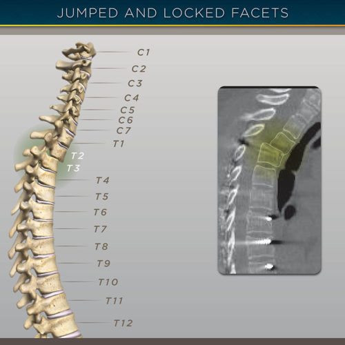 Spinal Jumped & Locked Facets