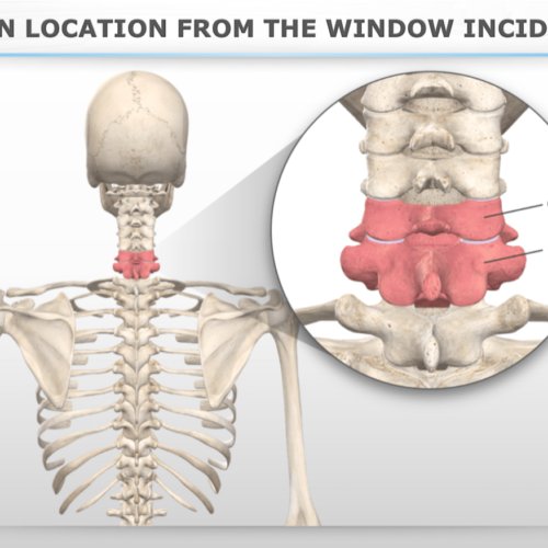 Spinal Pain